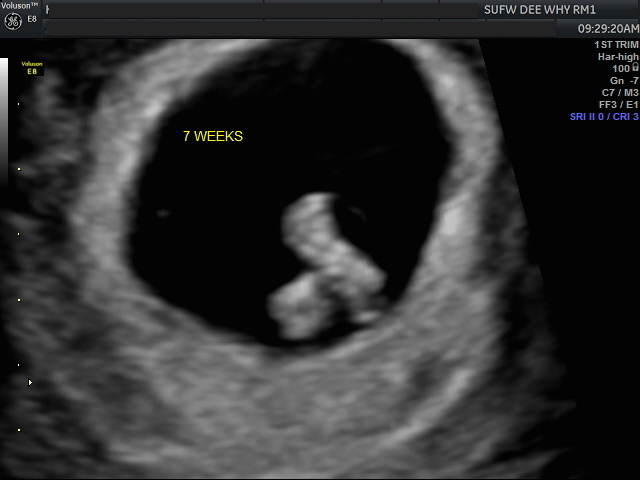 should there be a heartbeat at 7 weeks